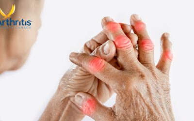 Arthritis in Canada: New Research on Awareness, Perceptions, and Economic Impact